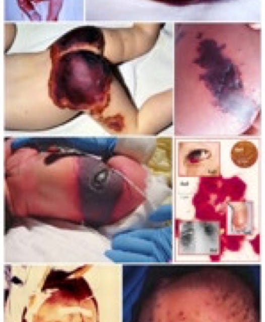 Neisseria Meningitis